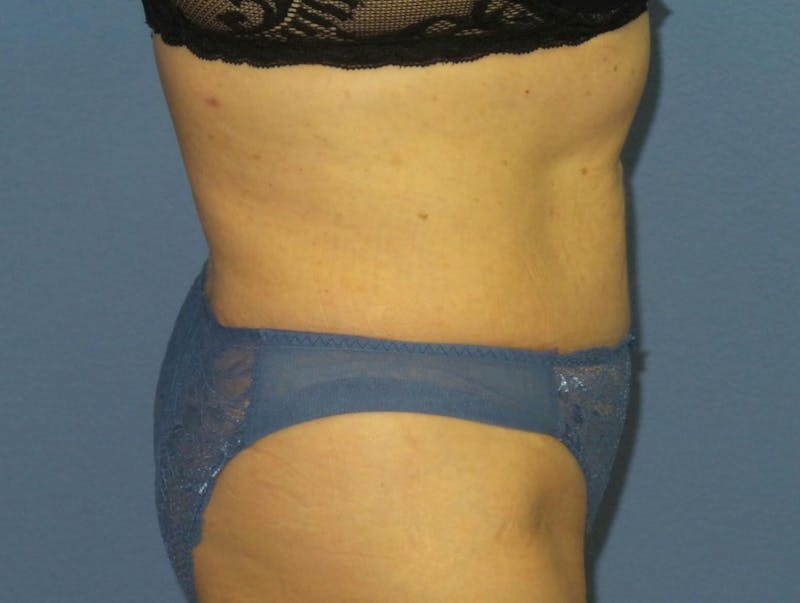 BodyTite™ Before and After Before & After Gallery - Patient 237245 - Image 4