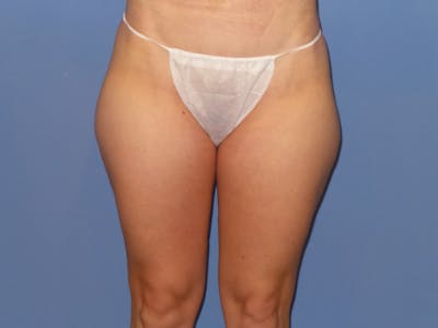 Liposuction Before & After Gallery - Patient 326089 - Image 1