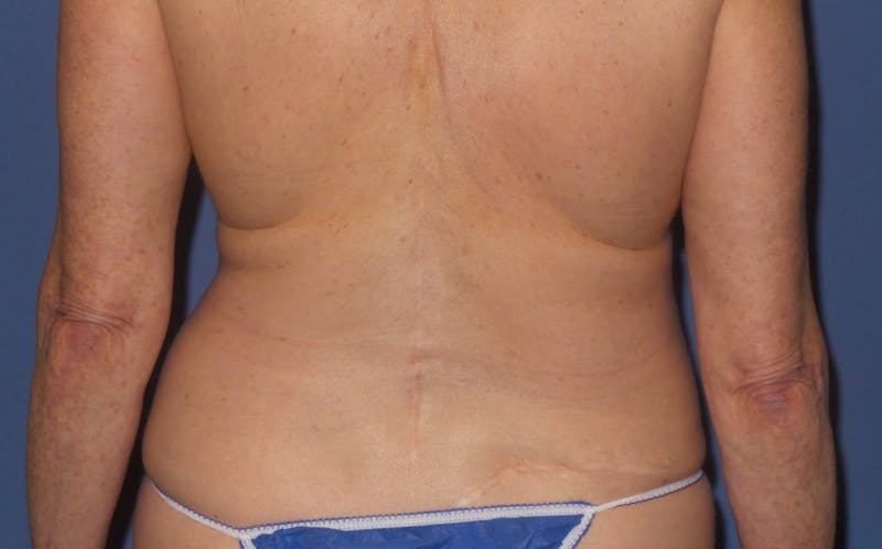 BodyTite™ Before & After Gallery - Patient 237245 - Image 5