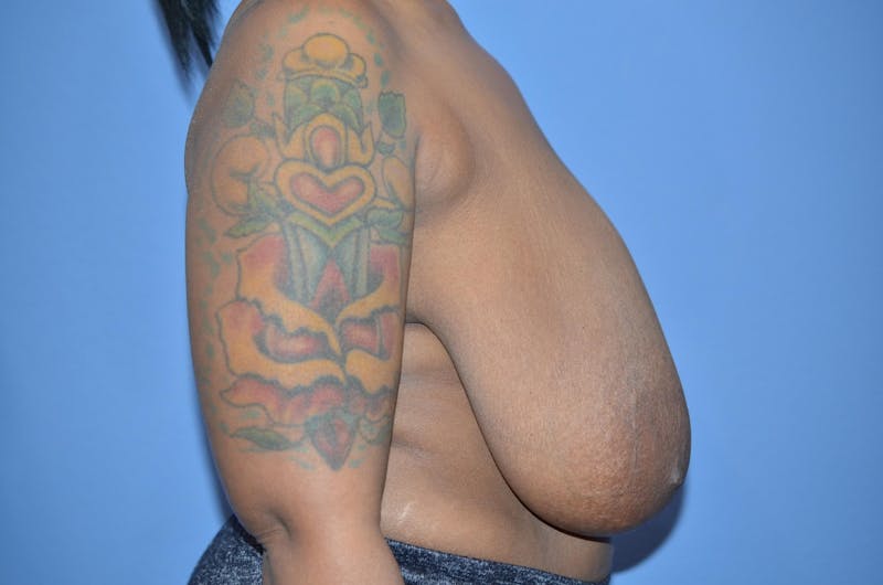 Breast Reduction Before & After Gallery - Patient 148632 - Image 3
