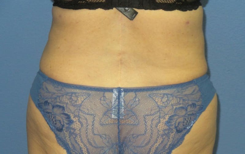 BodyTite™ Before and After Before & After Gallery - Patient 237245 - Image 6
