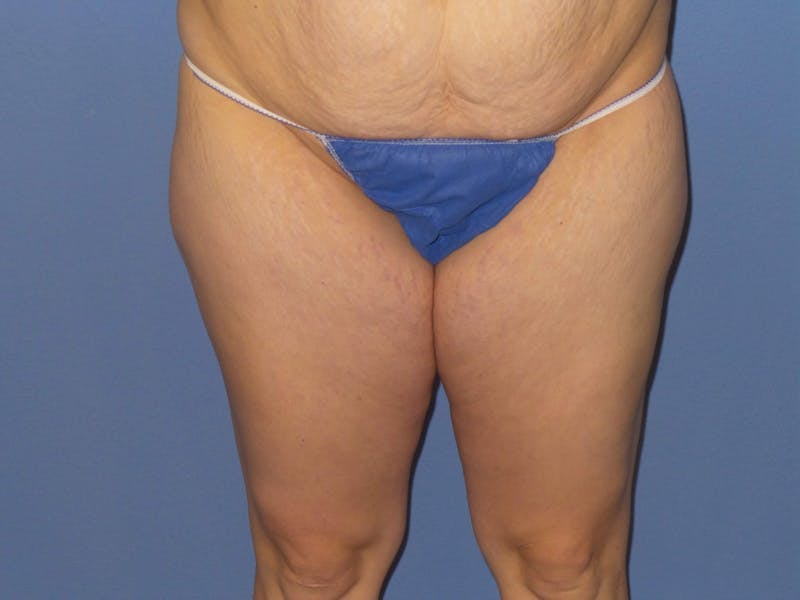 BodyTite™ Before & After Gallery - Patient 153566 - Image 1