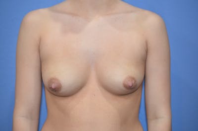 Breast Augmentation Before & After Gallery - Patient 397146 - Image 1