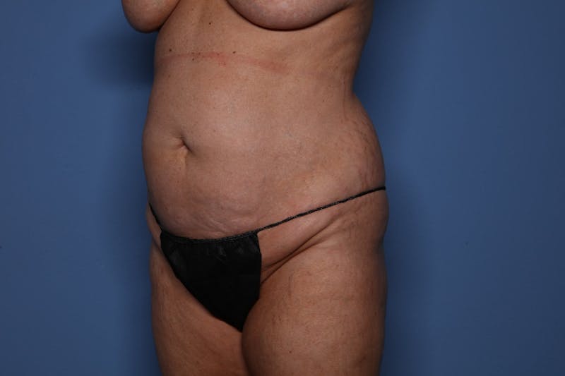 Tummy Tuck Before & After Gallery - Patient 961437 - Image 3