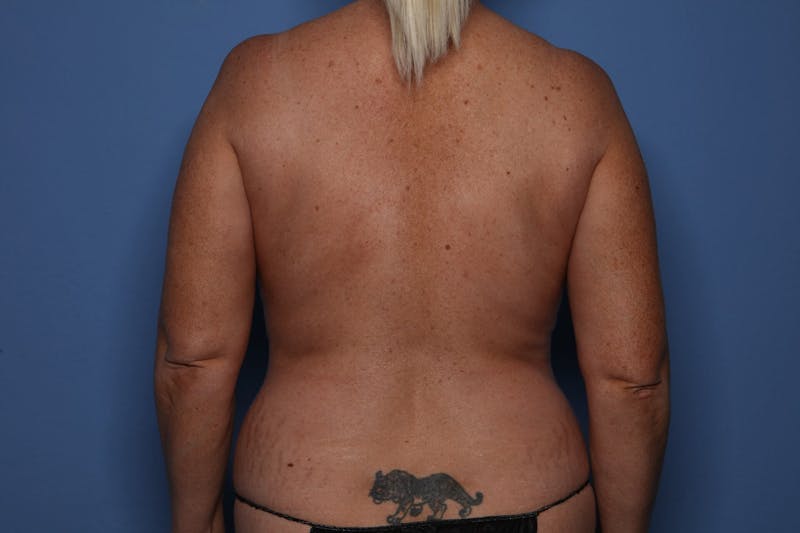 Tummy Tuck Before & After Gallery - Patient 961437 - Image 5