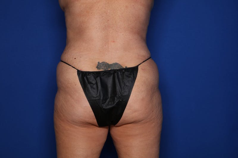 Tummy Tuck Before & After Gallery - Patient 961437 - Image 6