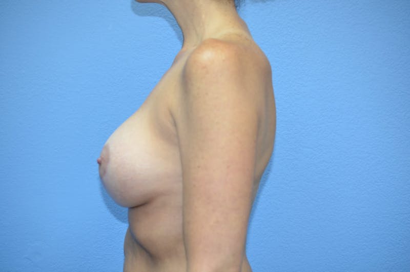 Breast Augmentation + Lift Before & After Gallery - Patient 260361 - Image 6