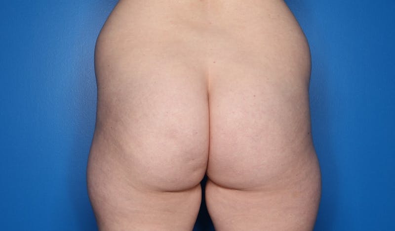 Liposuction Before & After Gallery - Patient 365643 - Image 1