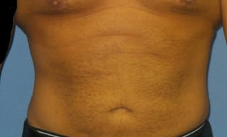 BodyTite™ Before and After Before & After Gallery - Patient 355589 - Image 2