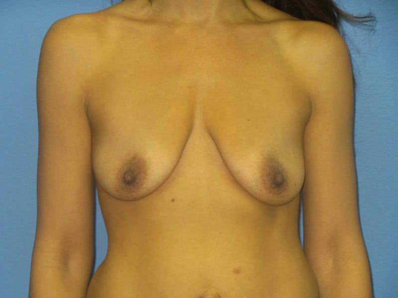 Breast Augmentation + Lift Before & After Gallery - Patient 822176 - Image 1