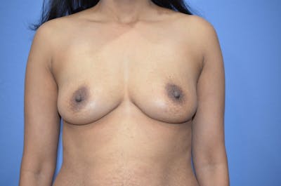 Breast Augmentation Before & After Gallery - Patient 917744 - Image 1