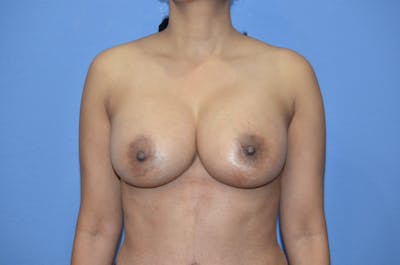 Breast Augmentation Before & After Gallery - Patient 917744 - Image 2