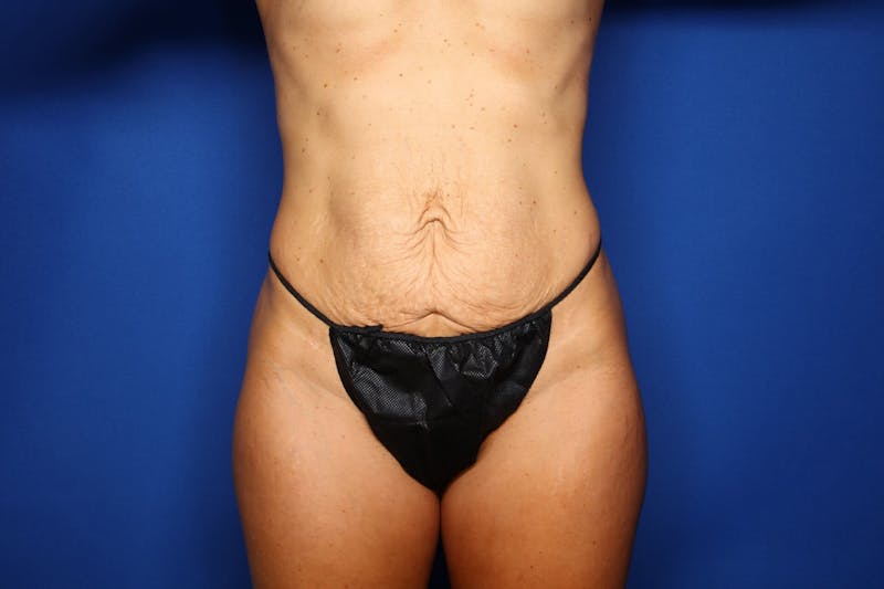 Tummy Tuck Before & After Gallery - Patient 412607 - Image 5