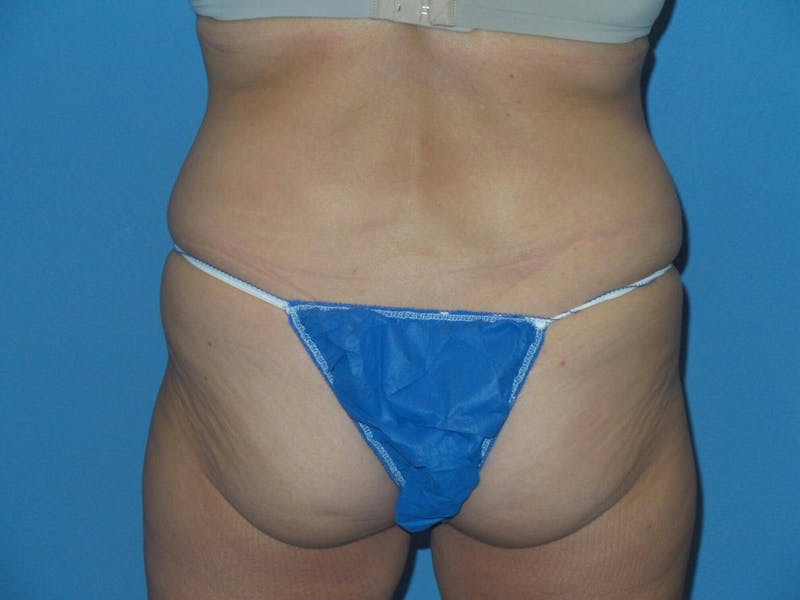BodyTite™ Before and After Before & After Gallery - Patient 146874 - Image 3