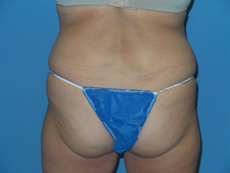 BodyTite™ Before & After Gallery - Patient 146874 - Image 3