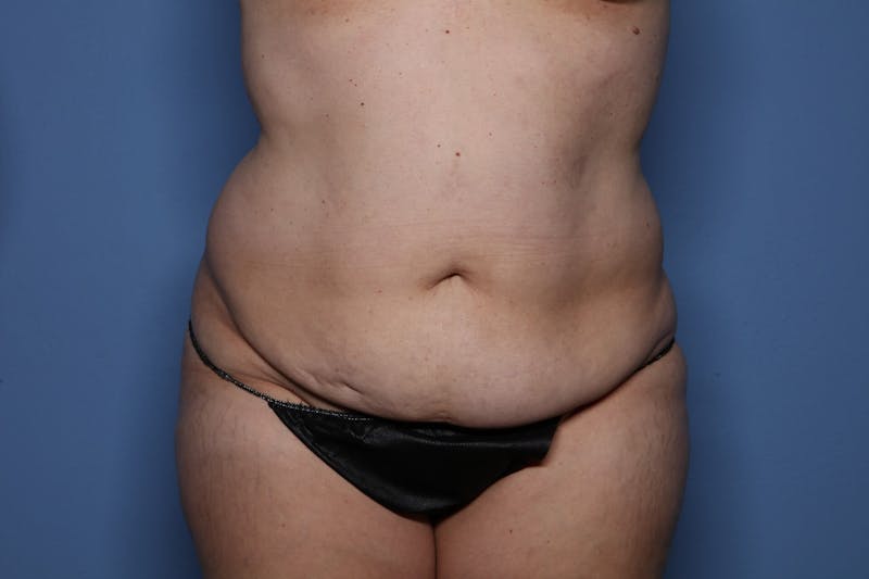 Tummy Tuck Before & After Gallery - Patient 107723 - Image 1