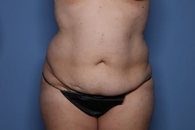 Tummy Tuck Before & After Gallery - Patient 107723 - Image 1