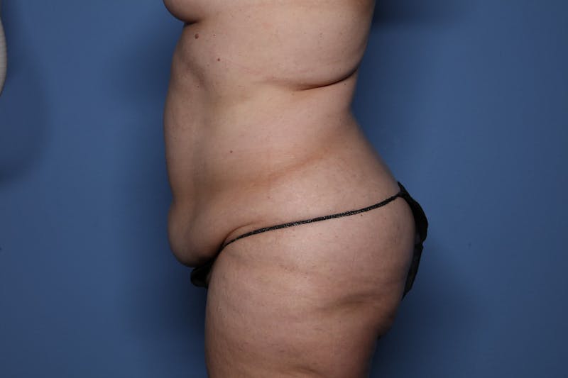 Tummy Tuck Before & After Gallery - Patient 107723 - Image 3