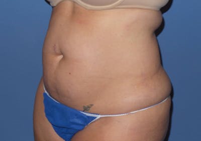Liposuction Before & After Gallery - Patient 132211 - Image 1