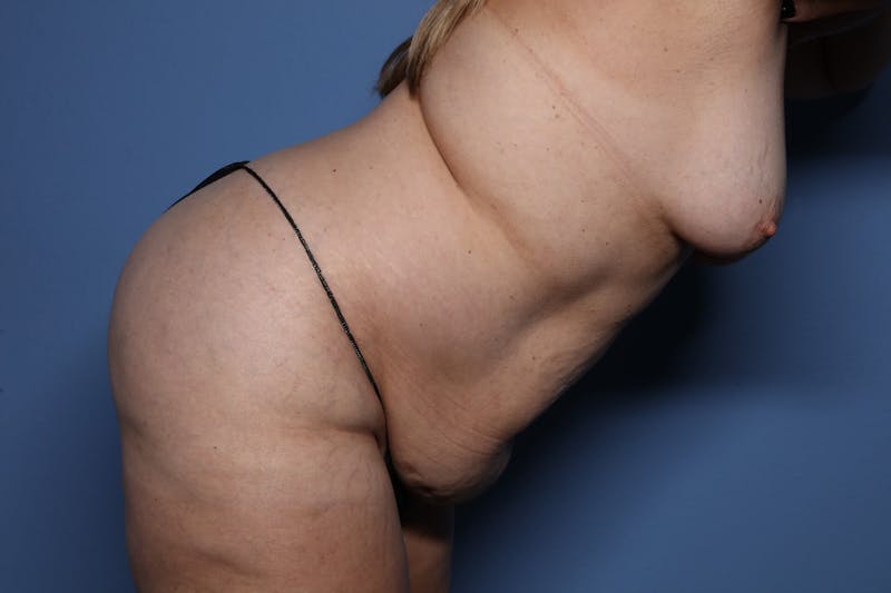 Tummy Tuck Before & After Gallery - Patient 107723 - Image 5