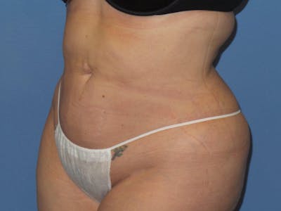 Liposuction Before & After Gallery - Patient 132211 - Image 2