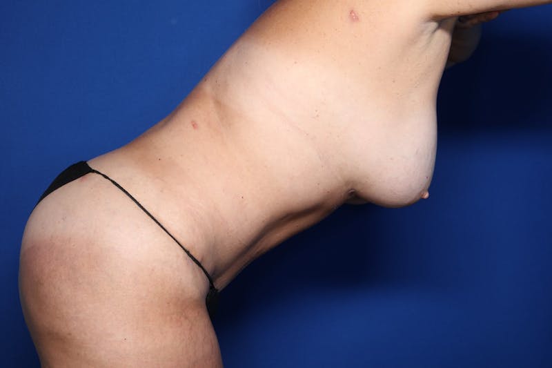 Tummy Tuck Before & After Gallery - Patient 107723 - Image 6