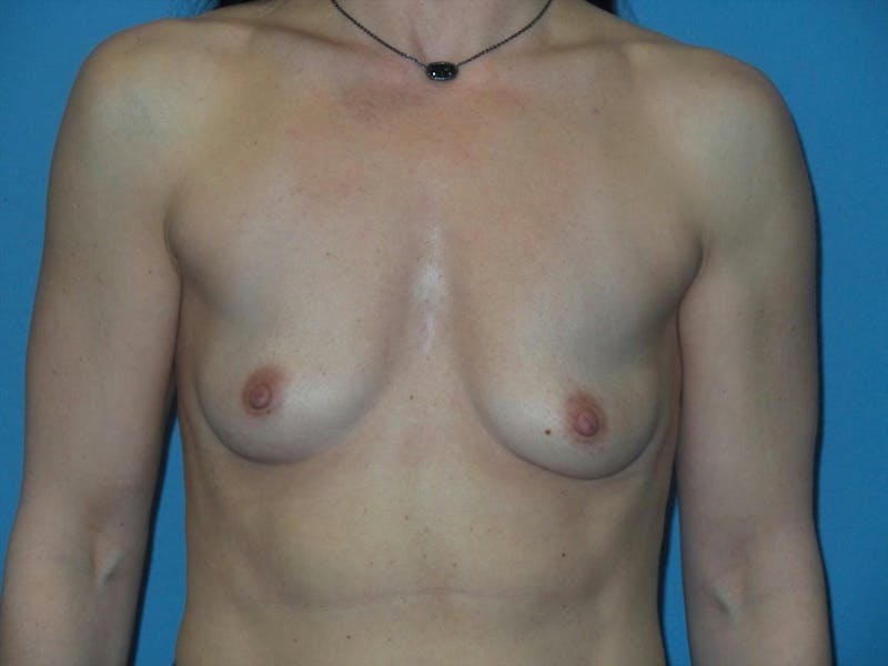 Breast Augmentation Before & After Gallery - Patient 339875 - Image 1