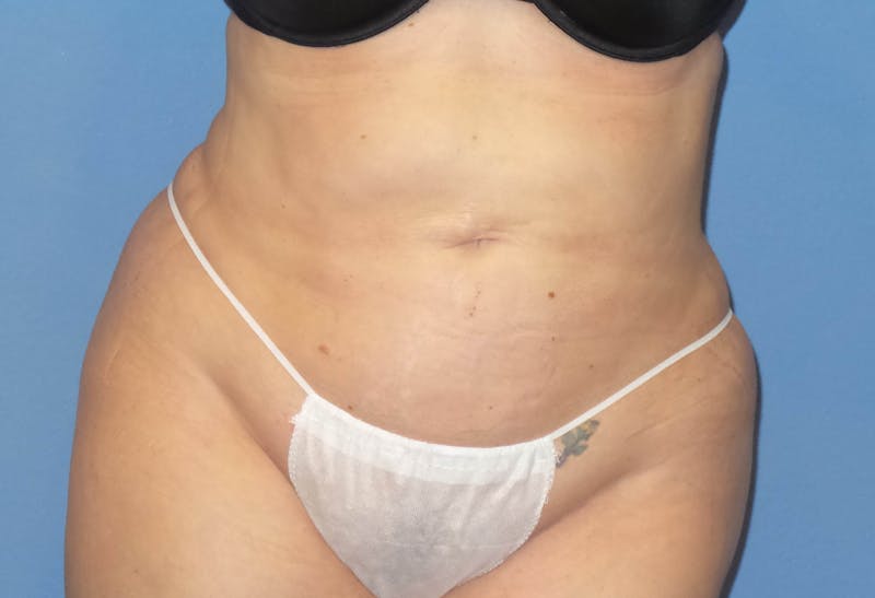 Liposuction Before & After Gallery - Patient 132211 - Image 4