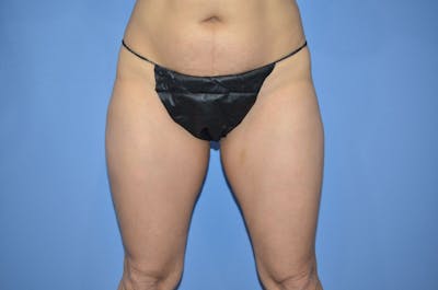 BodyTite™ Before & After Gallery - Patient 399770 - Image 1