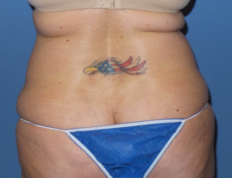 Liposuction Before & After Gallery - Patient 132211 - Image 5