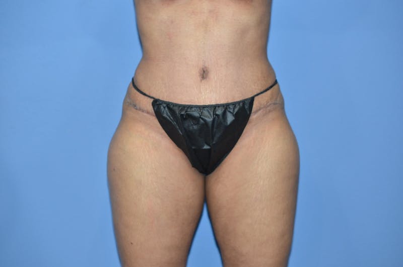 Tummy Tuck Before & After Gallery - Patient 119539 - Image 2