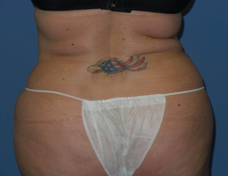 Liposuction Before & After Gallery - Patient 132211 - Image 6
