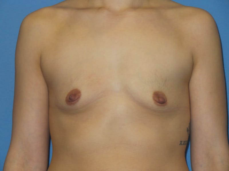 Breast Augmentation Before & After Gallery - Patient 220214 - Image 1