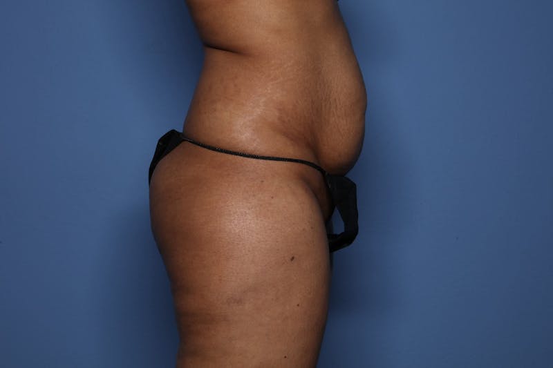 Tummy Tuck Before & After Gallery - Patient 119539 - Image 3
