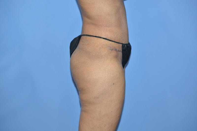 Tummy Tuck Before & After Gallery - Patient 119539 - Image 4