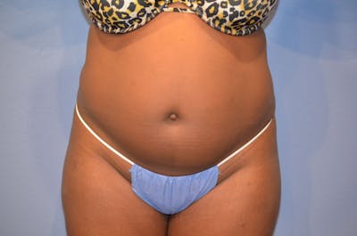 Liposuction Before & After Gallery - Patient 186811 - Image 1