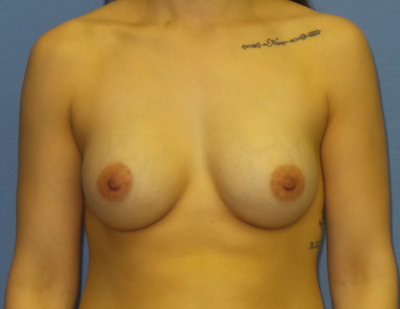Breast Augmentation Before & After Gallery - Patient 220214 - Image 2