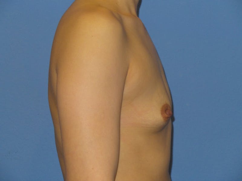 Breast Augmentation Before & After Gallery - Patient 220214 - Image 3