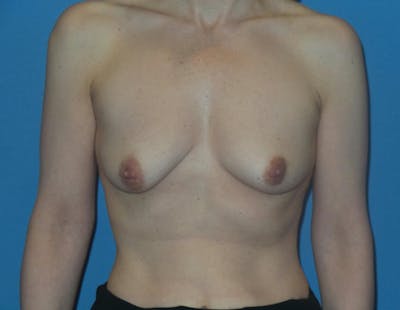 Breast Augmentation + Lift Before & After Gallery - Patient 124666 - Image 1