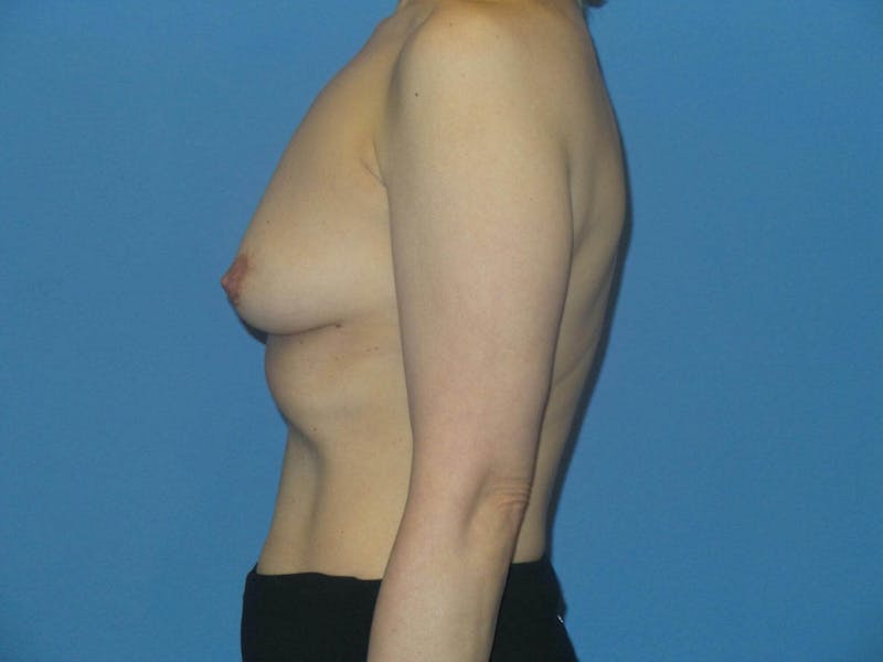 Breast Augmentation + Lift Before & After Gallery - Patient 124666 - Image 3