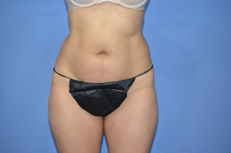 BodyTite™ Before & After Gallery - Patient 399770 - Image 7