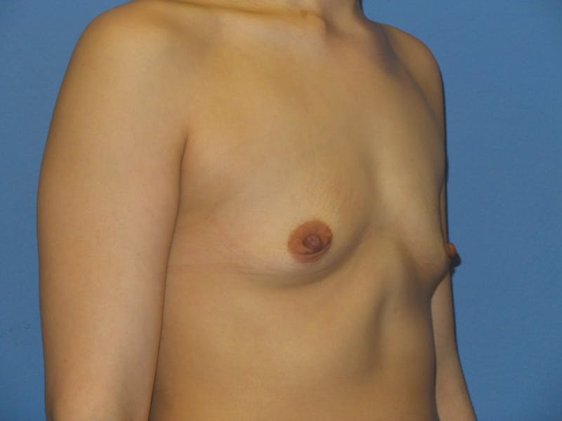 Breast Augmentation Before & After Gallery - Patient 220214 - Image 5