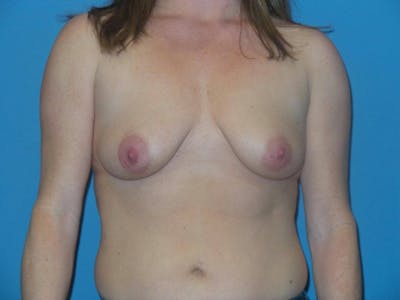 Breast Augmentation + Lift Before & After Gallery - Patient 378786 - Image 1