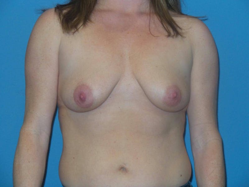 Breast Augmentation + Lift Before & After Gallery - Patient 378786 - Image 1