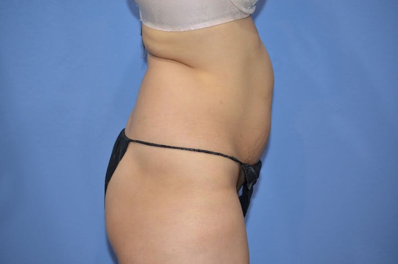 BodyTite™ Before & After Gallery - Patient 399770 - Image 9