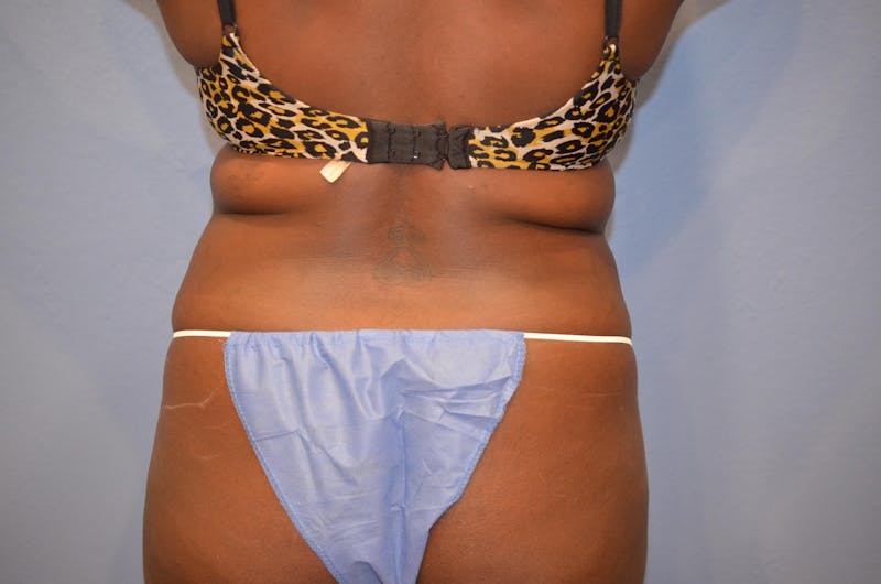 Liposuction Before & After Gallery - Patient 186811 - Image 7