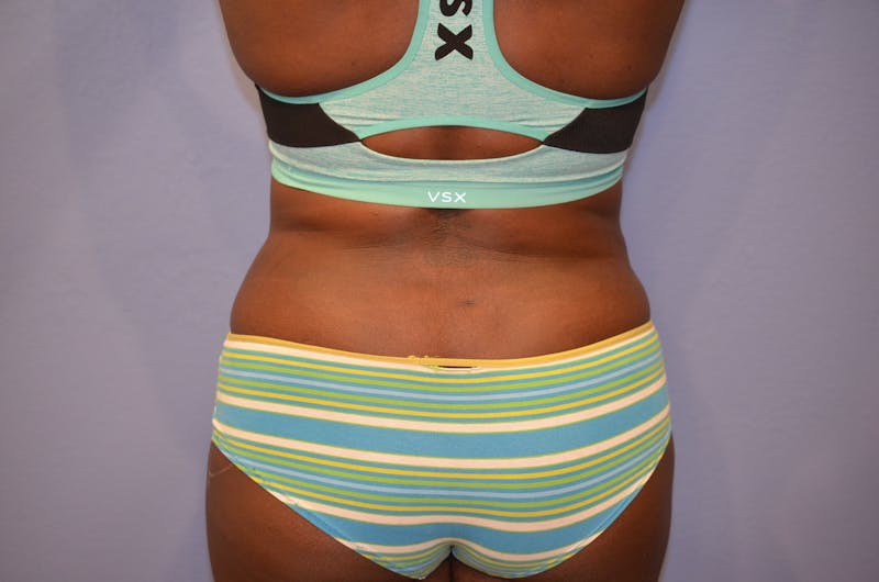 Liposuction Before & After Gallery - Patient 186811 - Image 8