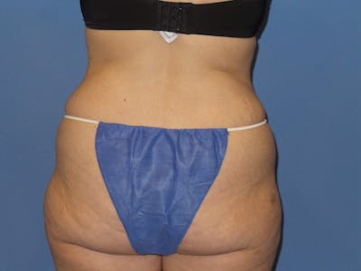 Liposuction Before & After Gallery - Patient 313048 - Image 1