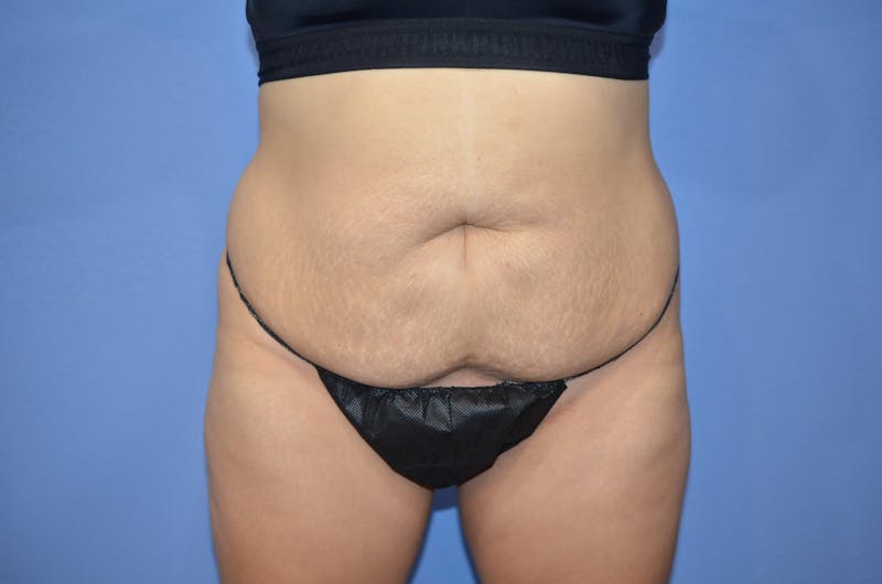Tummy Tuck Before & After Gallery - Patient 364563 - Image 1