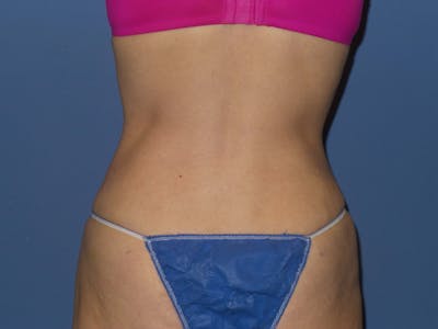 Liposuction Before & After Gallery - Patient 313048 - Image 2